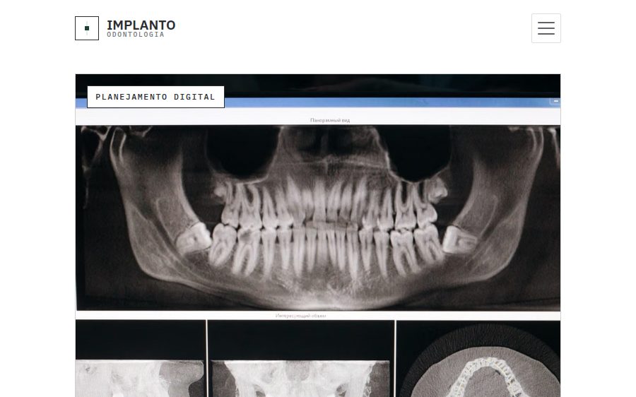 Prévia do template implanto-dental